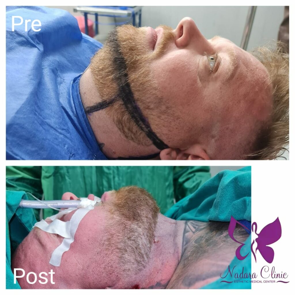 Double chin treatment in Hurghada